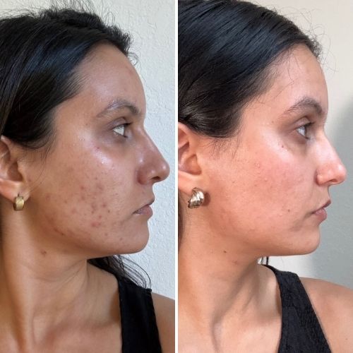 Before and after clearer skin result