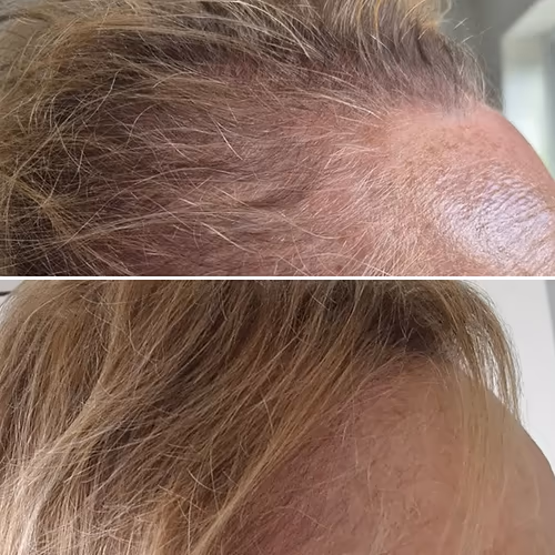 Before and after fuller hairline result