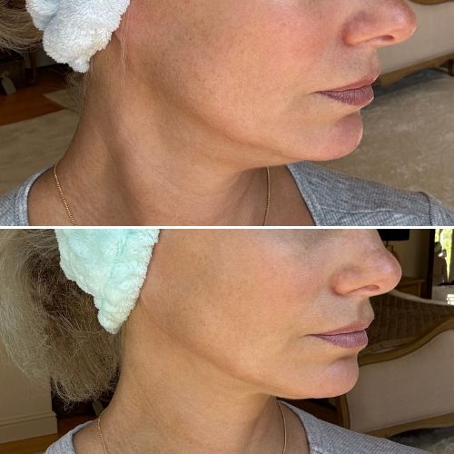 Before and after brighter complexion result