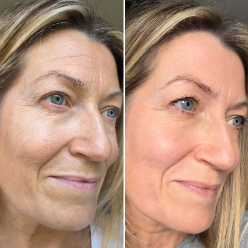 Before and after fine lines and wrinkles result