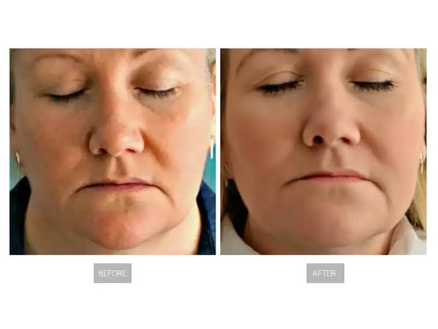 RF vs LED Therapy: Differences, Benefits and Which Is Better?